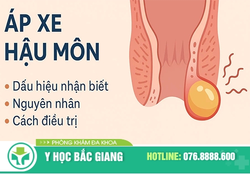 Tổng hợp những điều bạn cần biết về apxe hậu môn