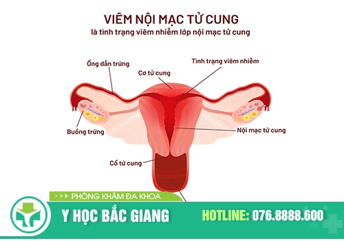 Viêm nội mạc tử cung: Dấu hiệu, nguyên nhân và cách điều trị
